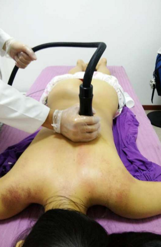 拔罐能治颈椎病吗